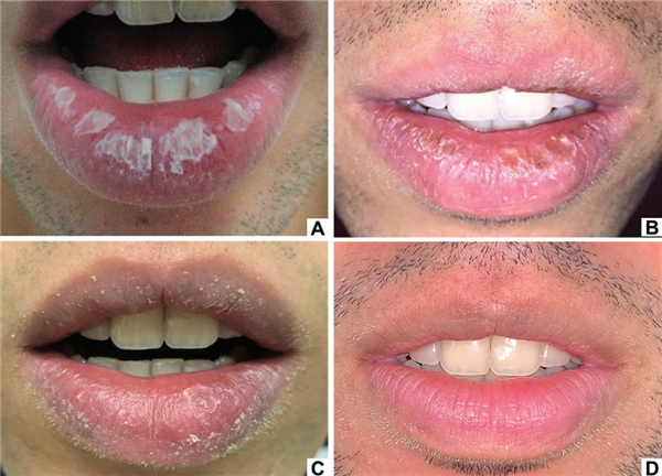 嘴唇总是干裂、起皮:可能不是水喝少了 而是得了这种病!-图5 嘴唇总是干裂、起皮:可能不是水喝少了 而是得了这种病!-图5