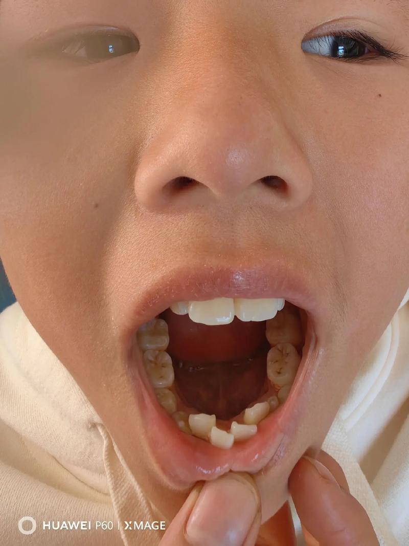 篮球牙套戴上还是下?篮球牙套戴上老突出来怎么办