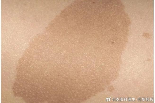 牛奶咖啡斑和白斑并存?牛奶咖啡斑发病率高吗