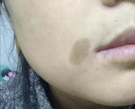 牛奶咖啡斑和白斑并存?牛奶咖啡斑发病率高吗