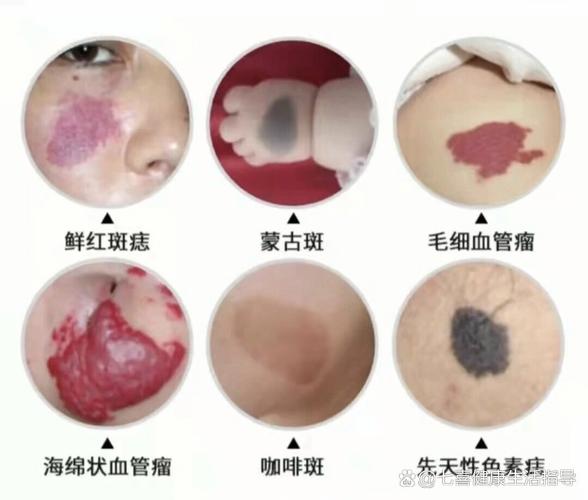 牛奶咖啡斑和白斑并存?牛奶咖啡斑发病率高吗