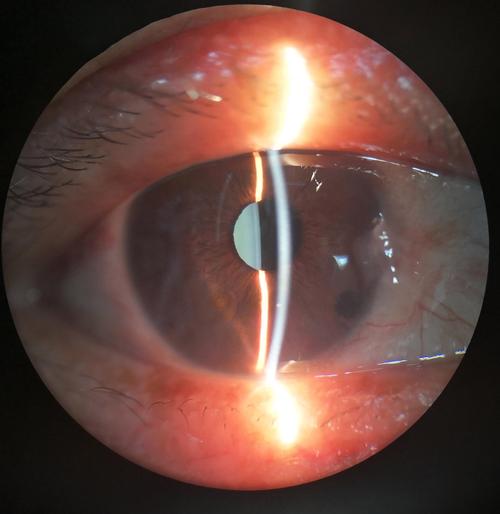 青睫综合症饮食要怎么注意呢?青睫综合症有什么忌口吗?