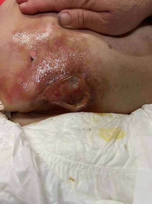 烂尾炎是什么症状？烂尾炎的正兆有那些