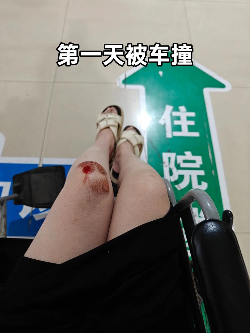 骑摩托车摔跤擦伤腿皮后又紧又痛？骑摩托车摔倒皮外伤怎么止疼