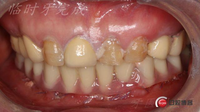 种植二期病例怎么写?种植二期病例怎么写的