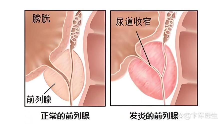 前列腺梗阻有什么症状?前列腺肠梗阻