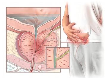 前列腺梗阻有什么症状?前列腺肠梗阻