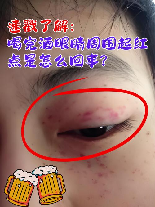 喝酒眼睛红是什么原因造成的？喝酒眼睛红是什么原因造成的呢