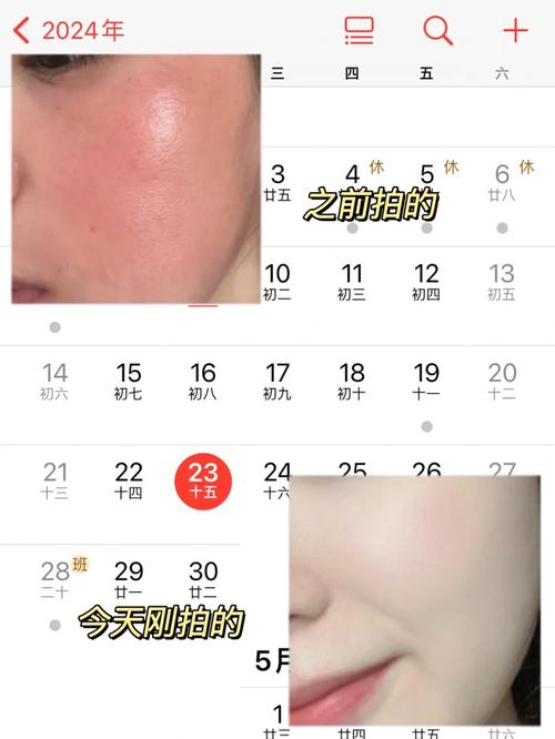 皮肤晒伤后一般几天能好?皮肤晒伤后多长时间能恢复