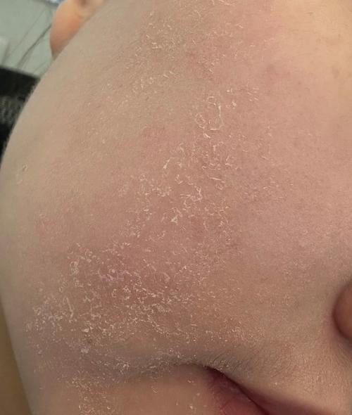 皮肤缺水会导致什么皮肤问题?皮肤缺水后会出现什么症状?