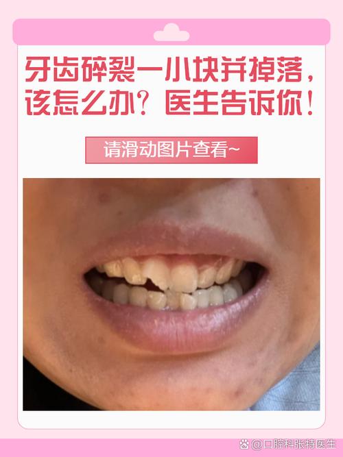 牙齿有碎渣掉下来？牙齿有碎渣脱落