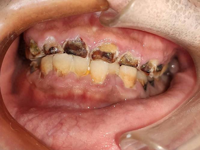 牙齿有碎渣掉下来?牙齿有碎渣脱落