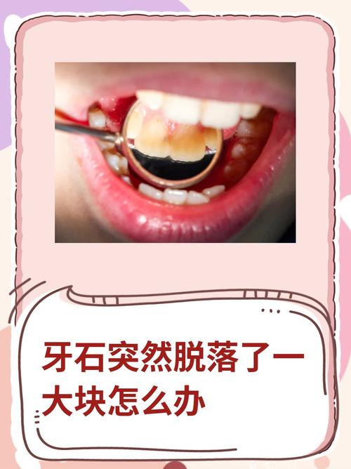 牙齿有碎渣掉下来?牙齿有碎渣脱落