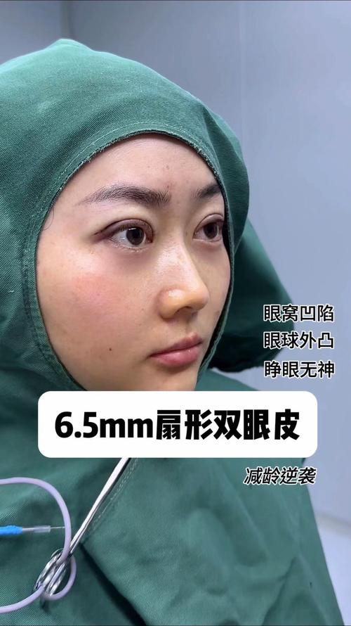 眼睛外凸怎么办恢复快？眼睛外凸怎么治疗