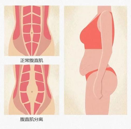盆底肌和腹直肌可以一起练吗?盆底肌和腹直肌有关联吗