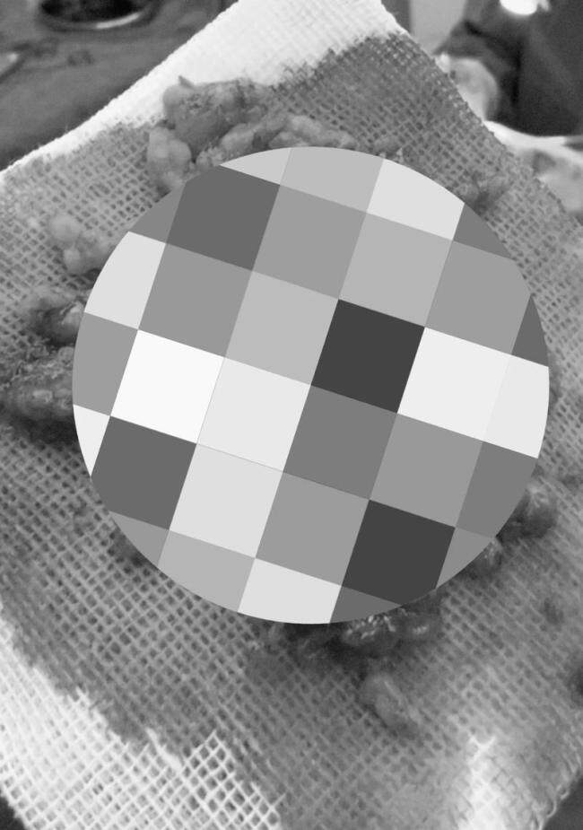 成本20元的表皮生长因子售价上万 非法注射引发面部毁容