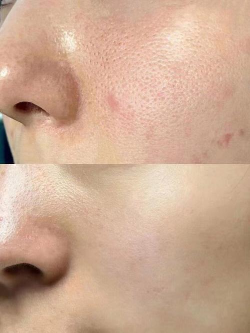 经常用爽肤水毛孔会变大吗？爽肤水会使毛孔变大吗