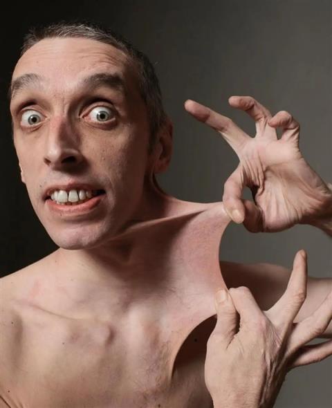 世界上皮肤最有“弹性”的男子 看完可能整个人都不好了(图2)