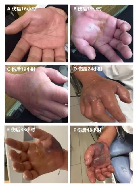 男子处理海鲜被扎伤 几天后突然去世!这些雷区你得知道(图4)