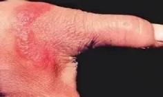 男子处理海鲜被扎伤 几天后突然去世!这些雷区你得知道(图6)