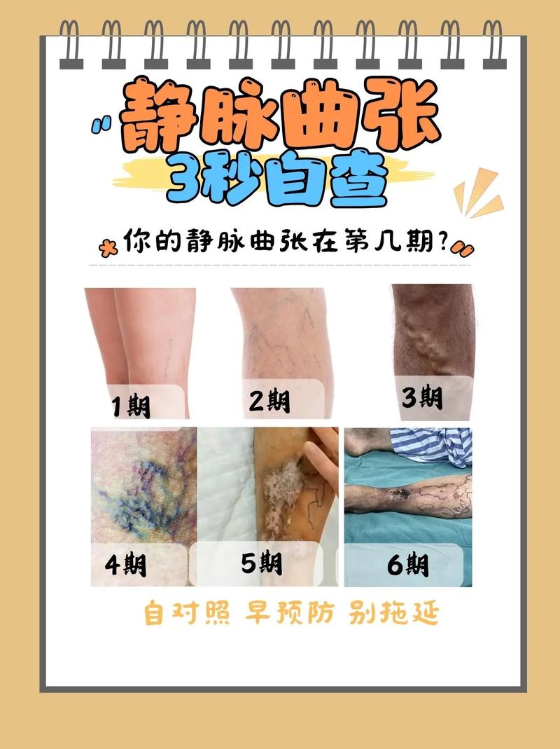 静脉曲张可以走长路吗?静脉曲张能不能走路