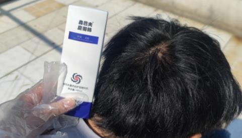 魔术丝能治秃顶吗？生发效果如何