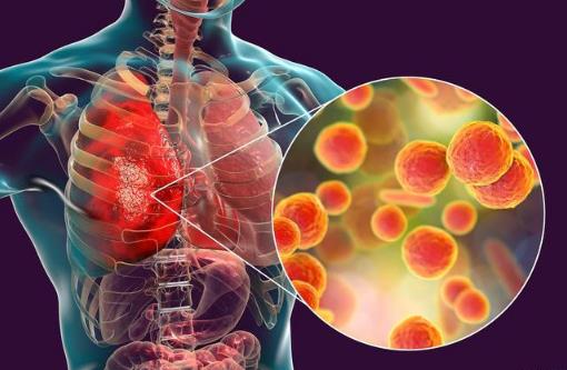 支原体肺炎会引发哮喘吗？如何预防儿童感染