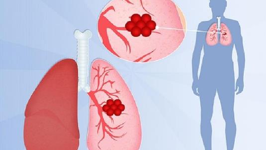 支原体肺炎会引发哮喘吗?如何预防儿童感染