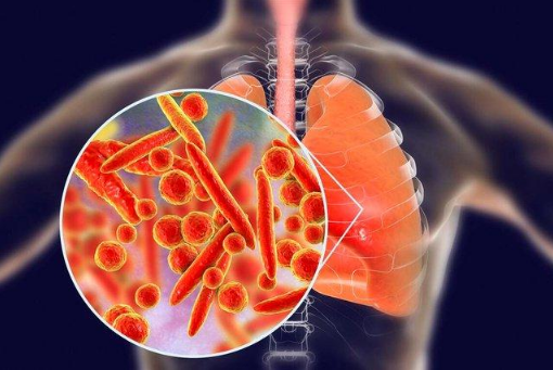 支原体肺炎症状表现?如何预防和应对