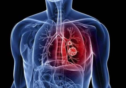 支原体肺炎发烧几天能退烧?会引发白肺吗