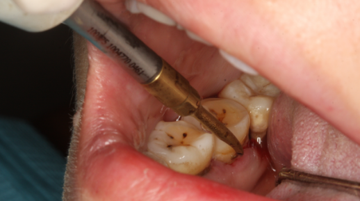 龈下刮治后更容易结石吗?如何预防复发