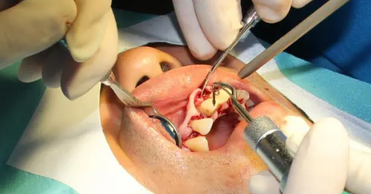 龈下刮治后更容易结石吗?如何预防复发