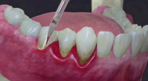 龈下刮治后更容易结石吗?如何预防复发