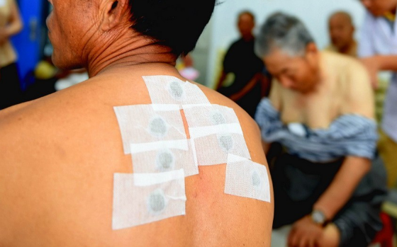 贴三伏贴后皮肤红痒还能继续贴吗？如何正确应对过敏