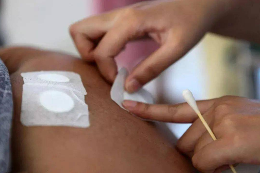 贴三伏贴针扎疼正常吗?如何缓解疼痛