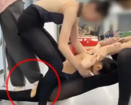 一舞蹈老师踩断了学生的腿，只愿赔偿5万元