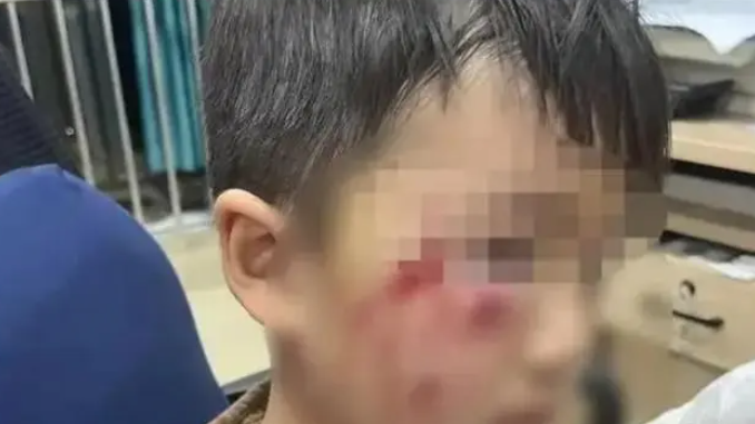 河南3岁男童被恶犬咬伤18天后离世，男童母亲发声