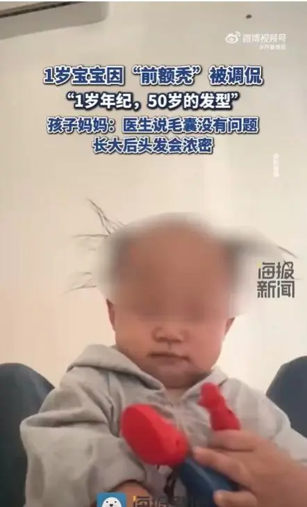 专家就婴幼儿前额秃现象进行情况汇总并提示心理影响